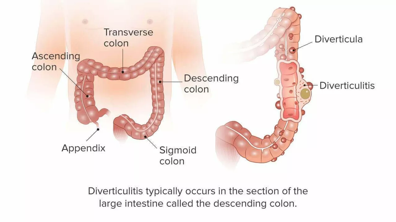 The Impact of Diverticulitis on Sleep Quality